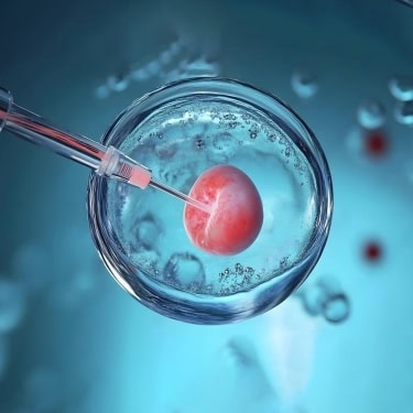 Preimplantation Genetic Screening